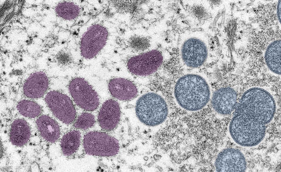 Digitally-colorized electron microscopic (EM) image depicting a monkeypox virion (virus particle). Courtesy CDC/Goldsmith at al. (Photo via Smith Collection/Gado/Getty Images)